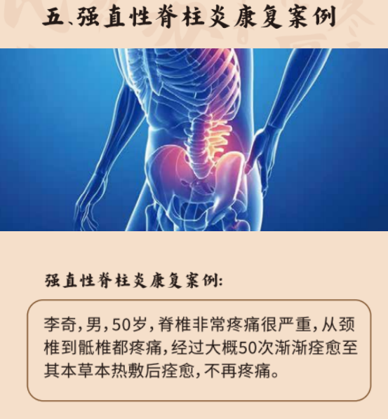 肩周炎康复案例展示，患者接受中药热敷治疗过程，医护人员专业指导，体现治疗效果